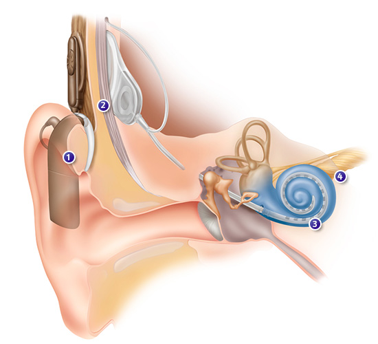 Diagrame du fonctionnement d'un implant cochléaire